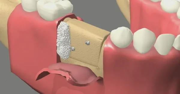 6 Benefits of Bone Grafting in Largo for Dental Implants 6 Benefits of Bone Grafting in Largo for Dental Implants
