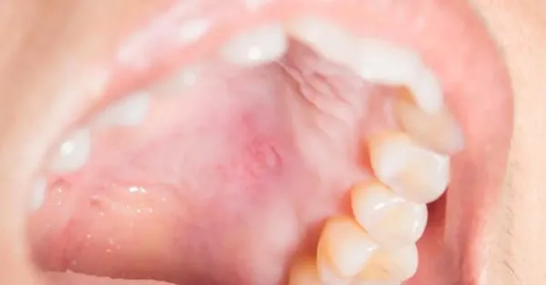 What causes a bump on the roof of the mouth? What causes a bump on the roof of the mouth?