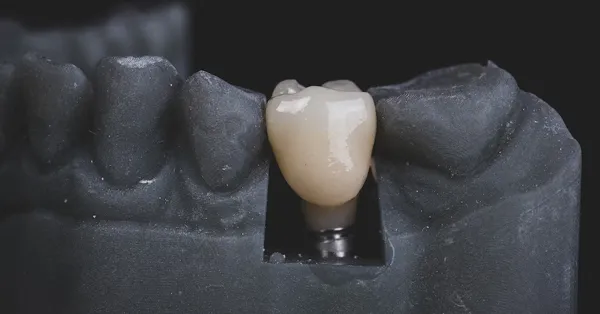 Dental Implants: A Great Alternative to Dentures and Bridges Dental Implants: A Great Alternative to Dentures and Bridges
