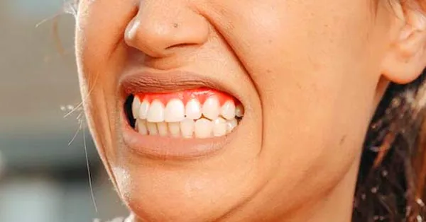 Gum Disease Gum Disease