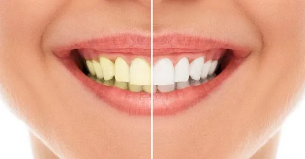 How to Get Whiter Teeth: Four Top Tips to Help Achieve a Brighter Smile How to Get Whiter Teeth: Four Top Tips to Help Achieve a Brighter Smile