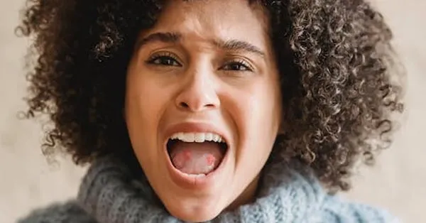 Mystery Solved: The Story on Canker Sores Mystery Solved: The Story on Canker Sores