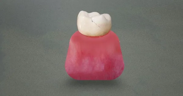 Traumatic Dental Injuries Traumatic Dental Injuries