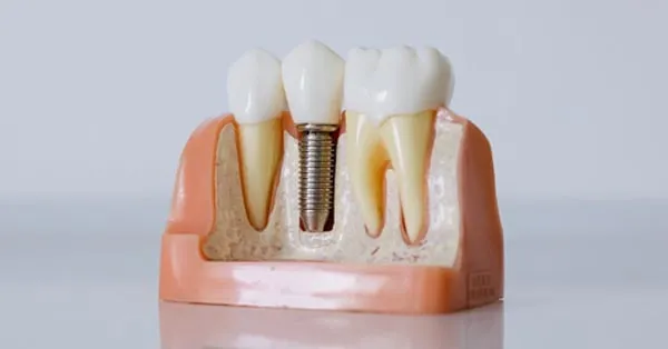 What Are Dental Implants? What Are Dental Implants?