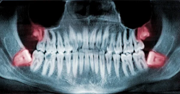 When Should I Have my Wisdom Teeth Removed? When Should I Have my Wisdom Teeth Removed?